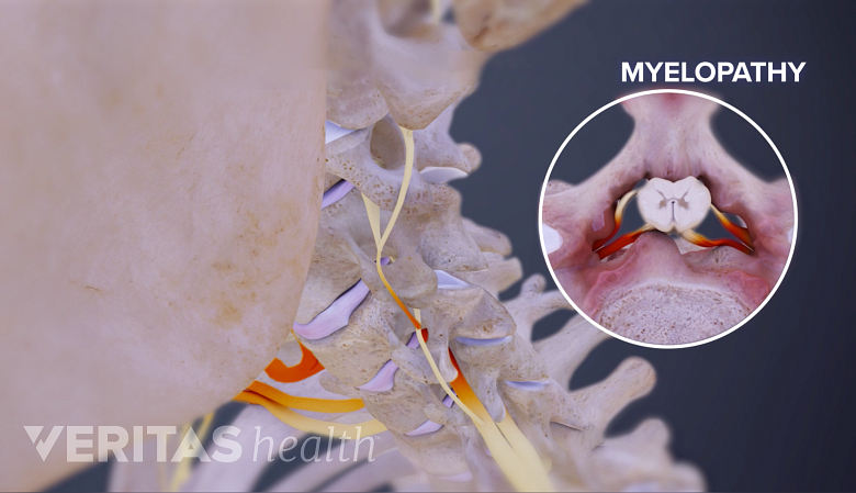 Cervical Spinal Stenosis - Complete Orthopedics