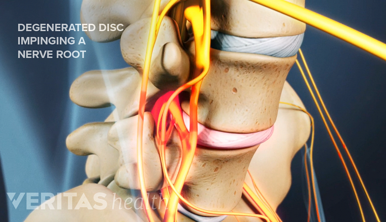 An illustration showing degeneration of the lumbar disc.