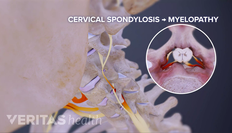 An illustration showing cervical myelopathy.