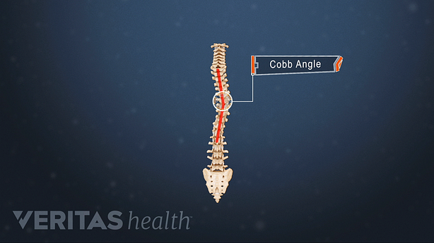 Spine showing the Cobb Angle of a thoracic scoliosis curve