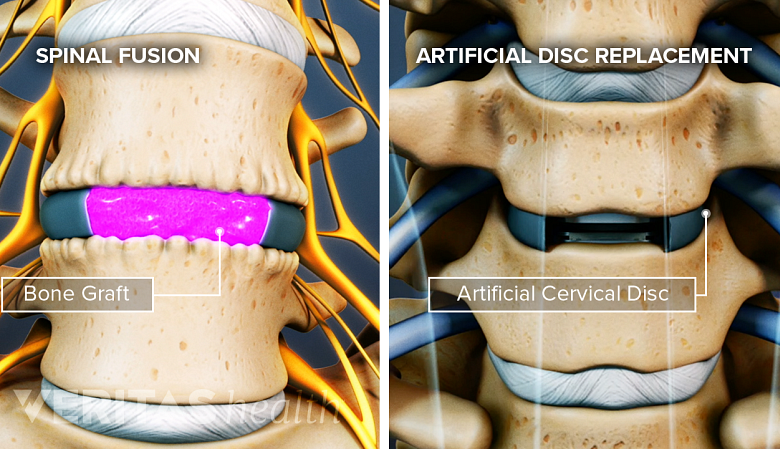 Illustration showing spinal fusion and artificial disc replacement.