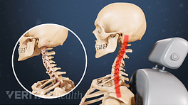 Profile view of how whiplash changes the shape of the cervical spine.