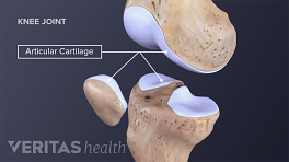 Medical illustration showing cartilage in a healthy knee