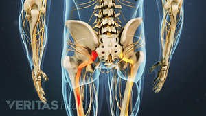 Posterior view of the pelvis showing sciatic pain traveling down the left leg.