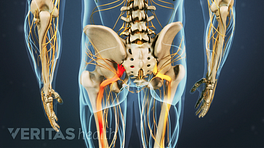 Posterior view of the pelvis showing sciatic pain traveling down the left leg.
