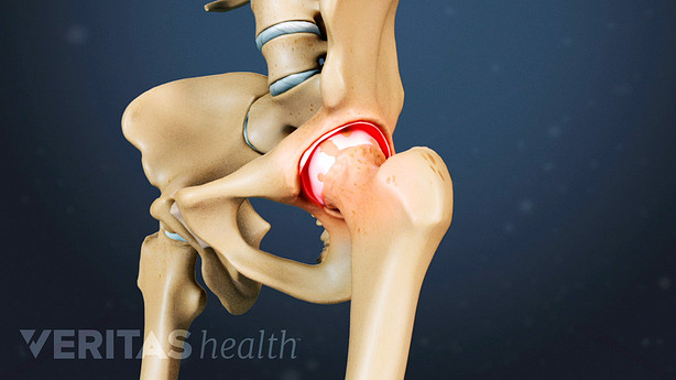 Medical illustration of osteoarthritis in the hip joint