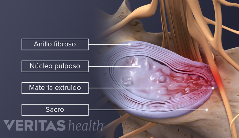 Los componentes de una hernia discal.