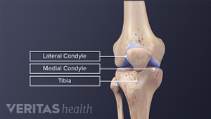 Medical illustration showing parts of the knee that are utilized during a tibial osteotomy.