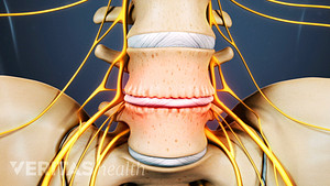 Anterior view of the lumbar spine with degenerative dis disease.