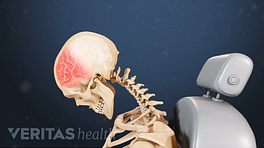 Profile view of whiplash impacting the neck and causing trauma to the front of the skull.