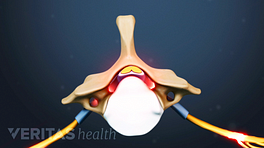 Superior view of a lumbar vertebra with a herniated disc causing spinal stenosis.