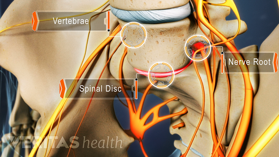 Animated video still of isthmic spondylolisthesis causing nerve root impingement