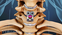 Anterior view of the cervical spine with a metal plate from ACDF.
