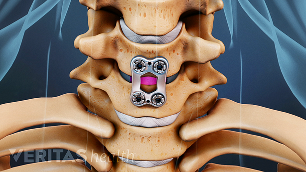 Medical illustration of the metal plate used across two vertebrae in an ACDF surgery