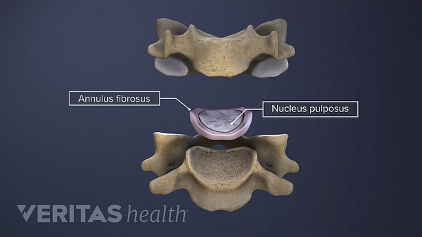 Núcleo de etiquetado del disco espinal, raíz nerviosa, anillo y vértebra lumbar.