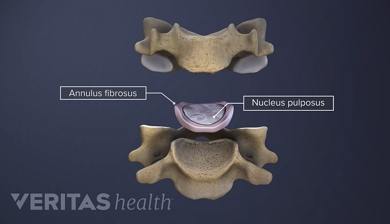 Spinal disc labeling nucleus, nerve root, annulus, and lumbar vertebra.