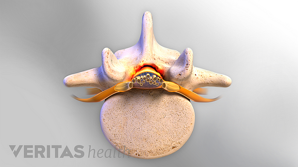 Una vértebra lumbar con estrechamiento del canal espinal y compresión de la médula espinal.