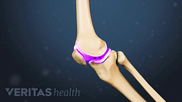 侧影显示膝关节软骨位于膝盖骨后面。