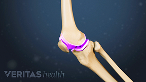 Profile view highlighting the cartilage in the knee joint behind the knee cap.