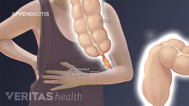 An illustration showing inflamed appendix.
