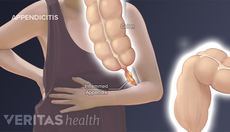 Medical illustration of appendicitits