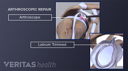 Arthroscopic repair of a labrum tear, highlighting the trimmed labrum and arthroscope