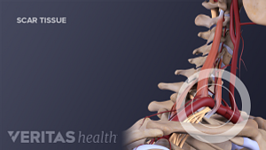 Profile view of the cervical spine labeling scar tissue.