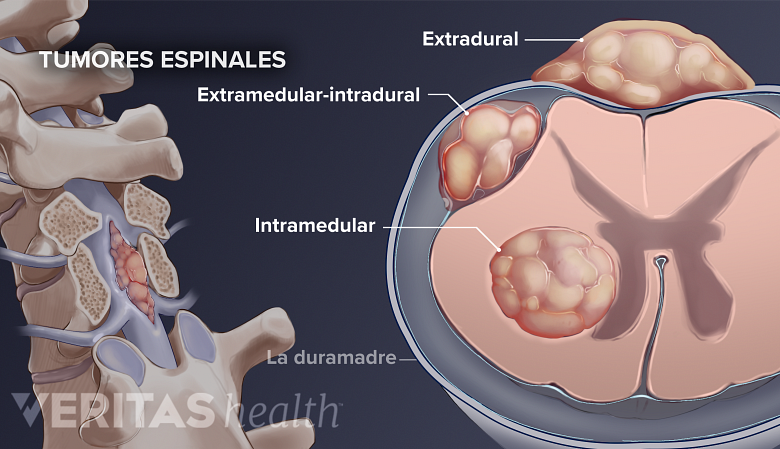 Tres tipos de tumores espinales: extradural, intradural-extmedular, intramedular.