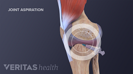 Medical illustration showing aspiration in a knee to reduce swelling