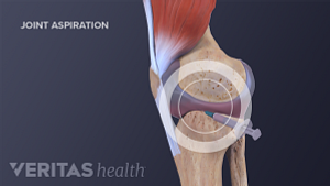 Medical illustration showing aspiration in a knee to reduce swelling