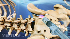 Vista posterior de la pelvis con inyección en la articulación SI