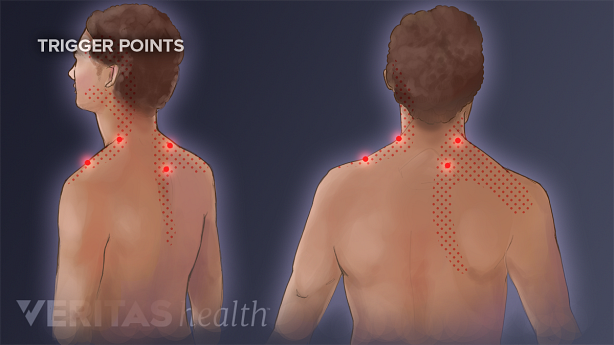 An illustration showing a man with trigger points on his neck highlighted in red.