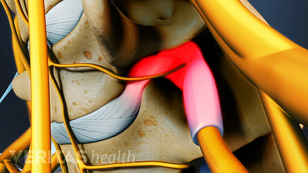 Medical illustration showing a herniated disc