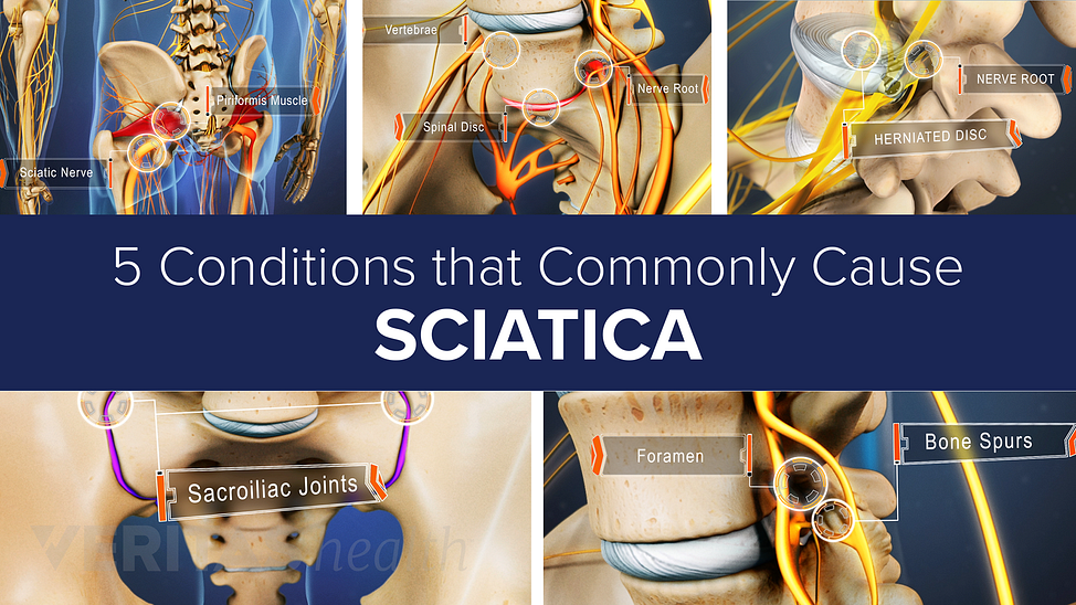 Five conditions that commonly cause sciatica slideshow cover