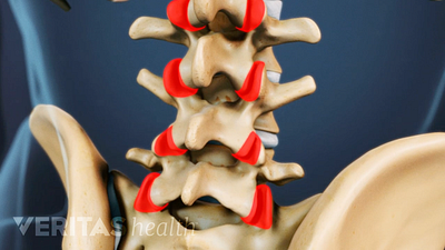 Close up view of a medical illustration of the lumbar spine. The facet joints are highlighted in red.