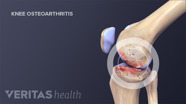 Medical illustration showing inflammation in the knee joint from knee osteoarthritis