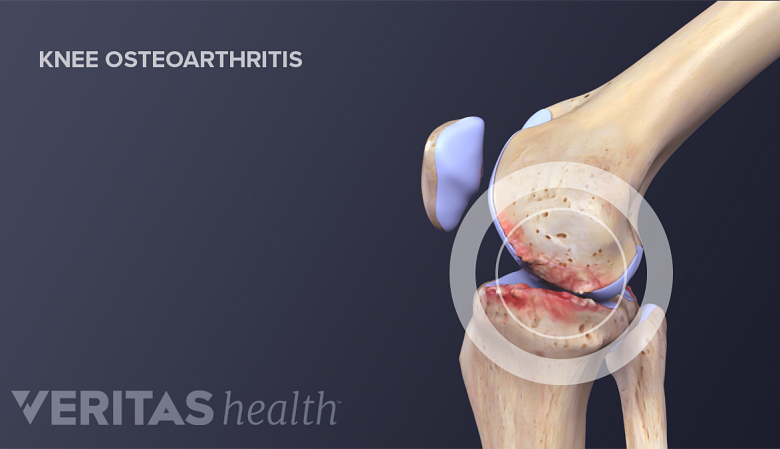 Medical illustration showing inflammation in the knee joint from knee osteoarthritis