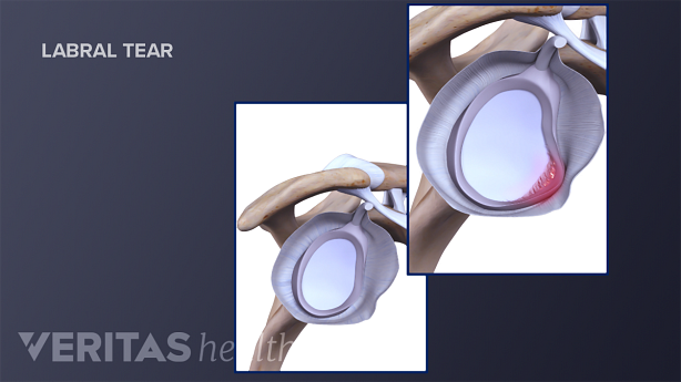 Anatomy of a SLAP tear compared to a health labrum