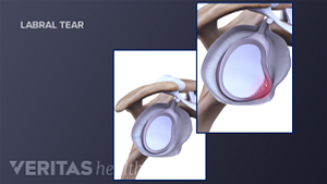 Anatomy of a SLAP tear compared to a health labrum