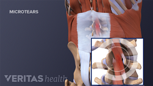 La ilustración médica de un microdesgarro son los músculos de la columna lumbar.