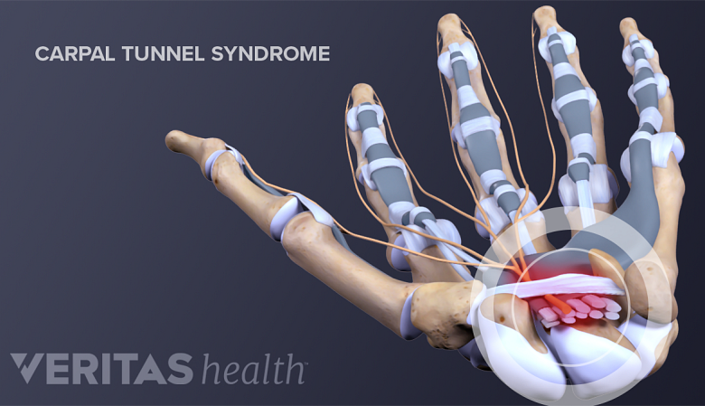 Anatomy of hand showing carpal tunnel syndrome.