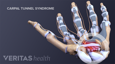 Medical illustration showing ligaments, tendons, and nerves involved in carpal tunnel syndrome