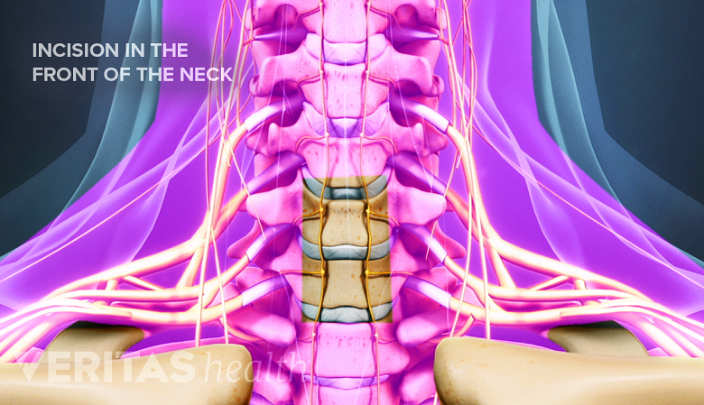 Illustration showing cervical vertebra with an incision in front of the neck.