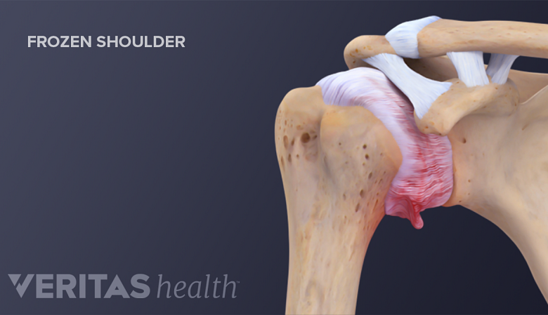 Cross section of normal joint compared to one with frozen shoulder (adhesive capsulitis).
