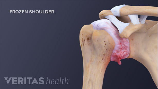 Illustration of a frozen shoulder joint