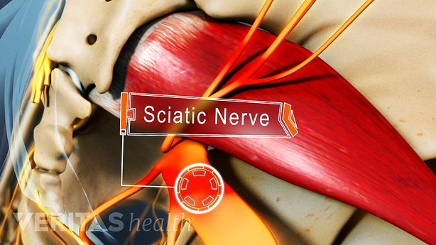 Medical illustration of the piriformis muscle and sciatic nerve
