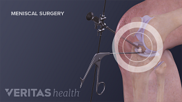 Instrumentation used in knee meniscal surgery