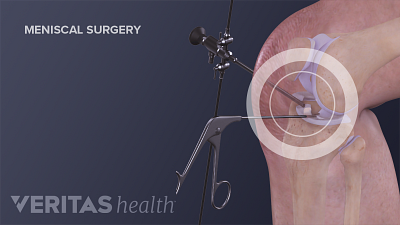 仪器使用期间被插入到膝盖半月板修复手术