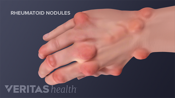 A hand with rheumatoid nodules at the joints