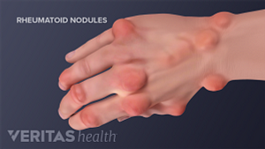 Hand with rheumatoid nodules on the joints.